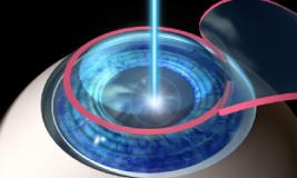 Лазерное лечение заболеваний глаз
