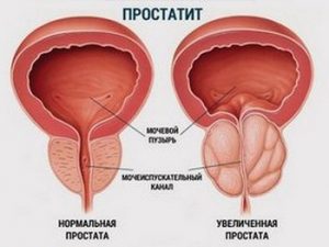 Простатит